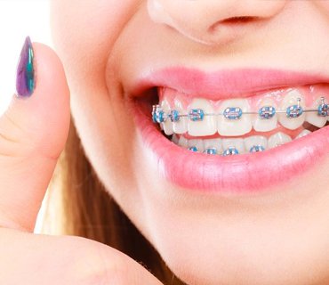 ortodoncia-brackets-adolescentes