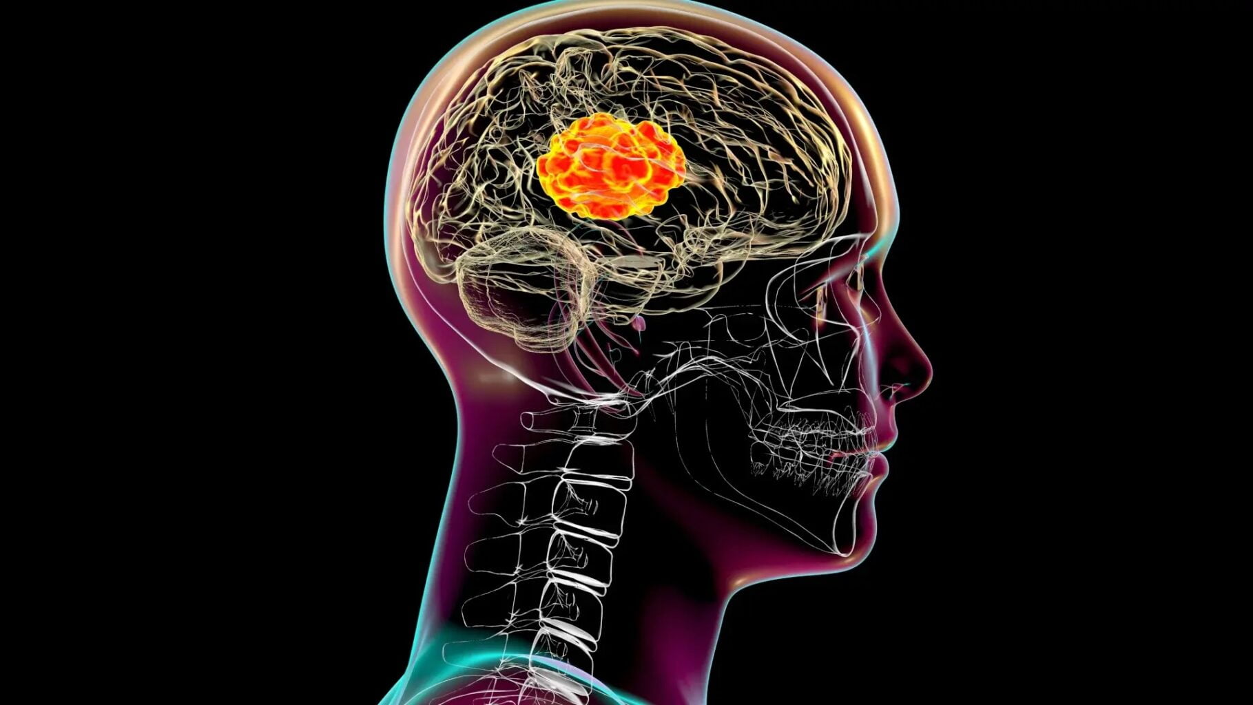 Las bacterias de la boca pueden ser causantes de absesos cerebrales. Es por ello que hay que lograr una buena salud bucal.