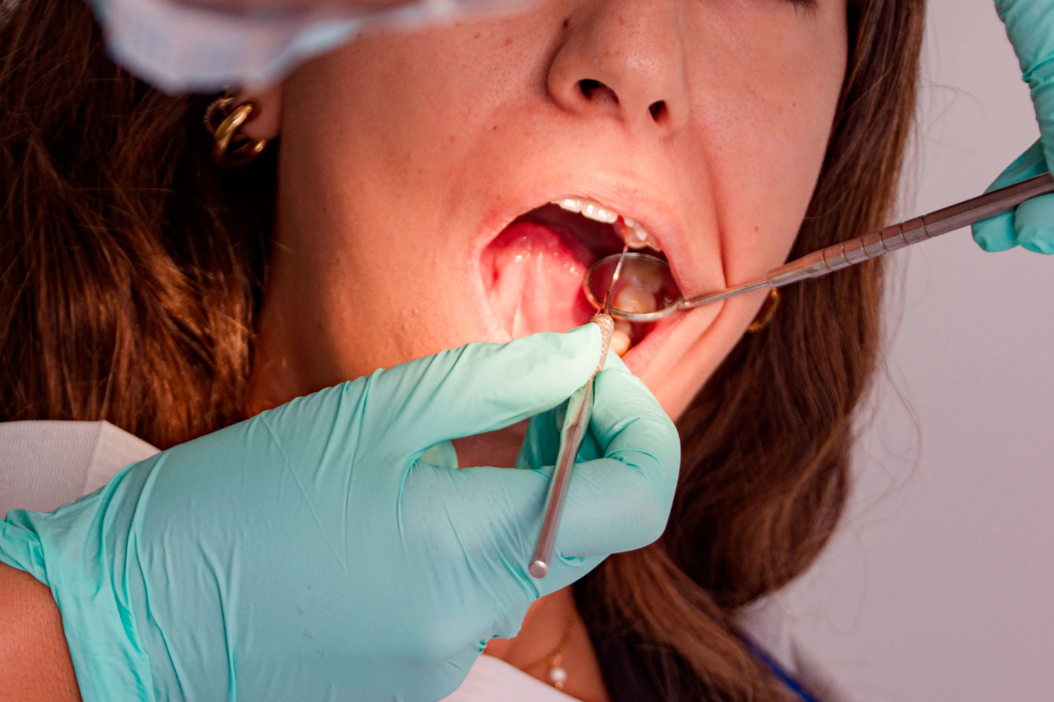 Rehabilitaciòn dental en un dìa en la Clìnica Odontològica BioSmile Montevideo Carrasco