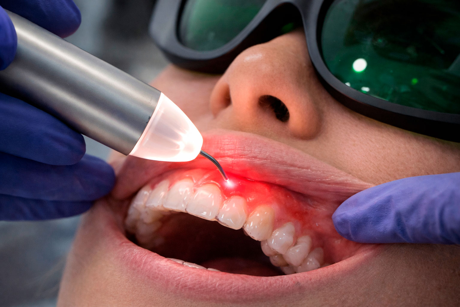 Láser odontológico utilizado para tratar la periodontitis sin cirugía tradicional