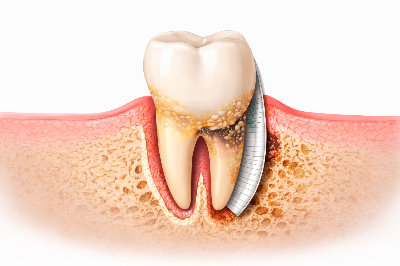 Ilustración odontológica horizontal del proceso de regeneración periodontal con recuperación de hueso y encía