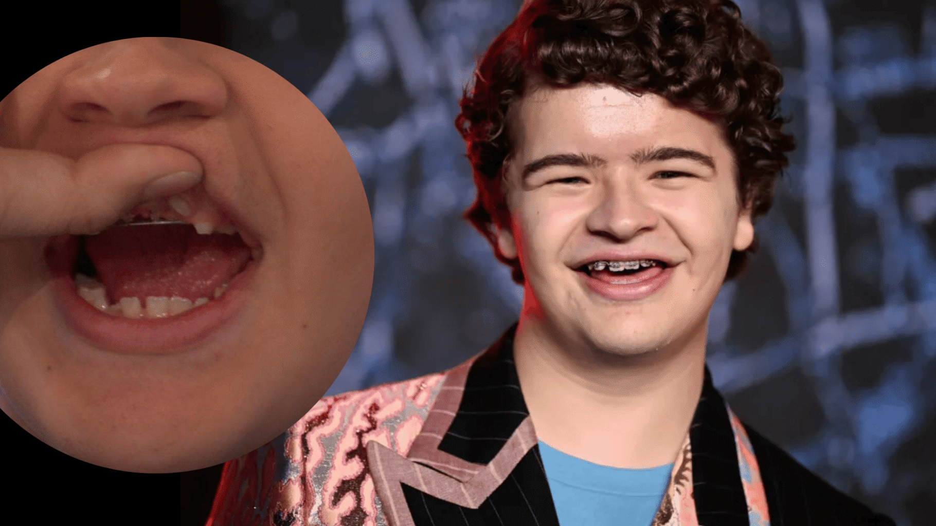 Gaten Matarazzo en Stranger Things, ejemplo real de displasia cleidocraneal y dientes retenidos.
